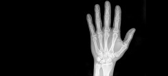 röntgen, x-ray, hand, gesundheit, medizin, untersuchung